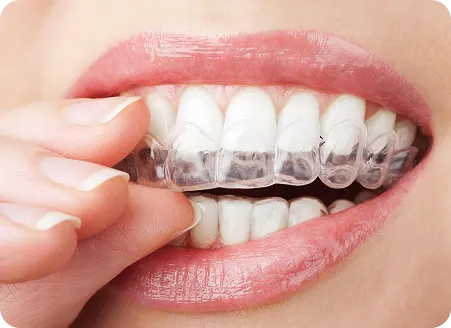 Teeth Straightening in Kingswood