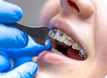 Straightforward Teeth Straightening with Visible or Discreet Braces