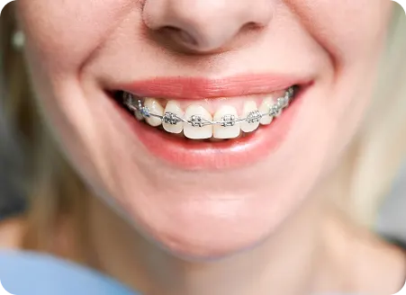 What to Expect from Your Braces Journey in Kingswood