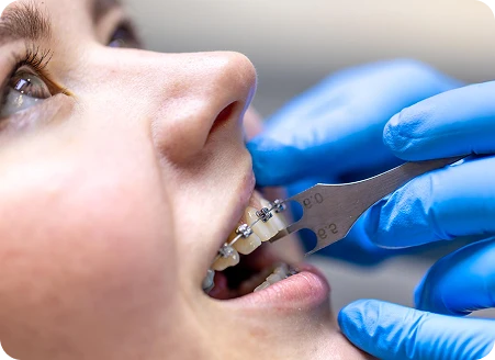 Who Can Get Braces?