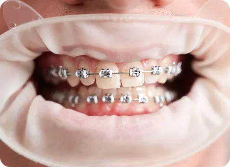 Teeth Straightening Made Easy – Choose Visible or Discreet Braces