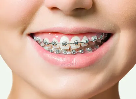 Braces for All Ages in Kingswood