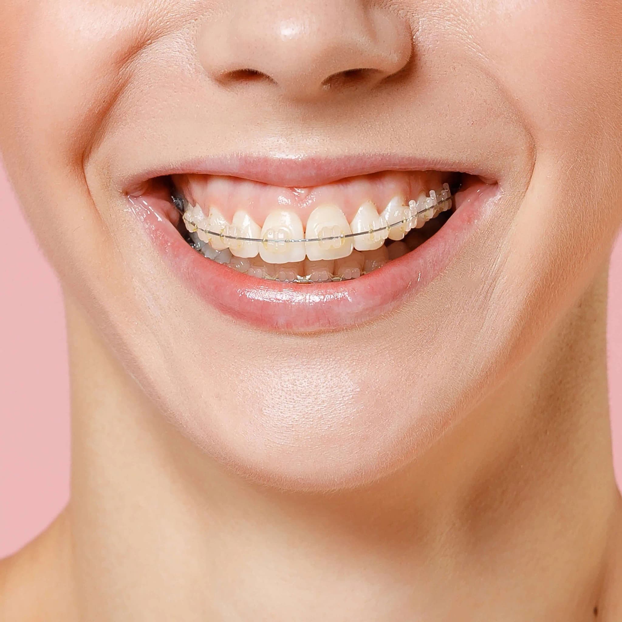 braces